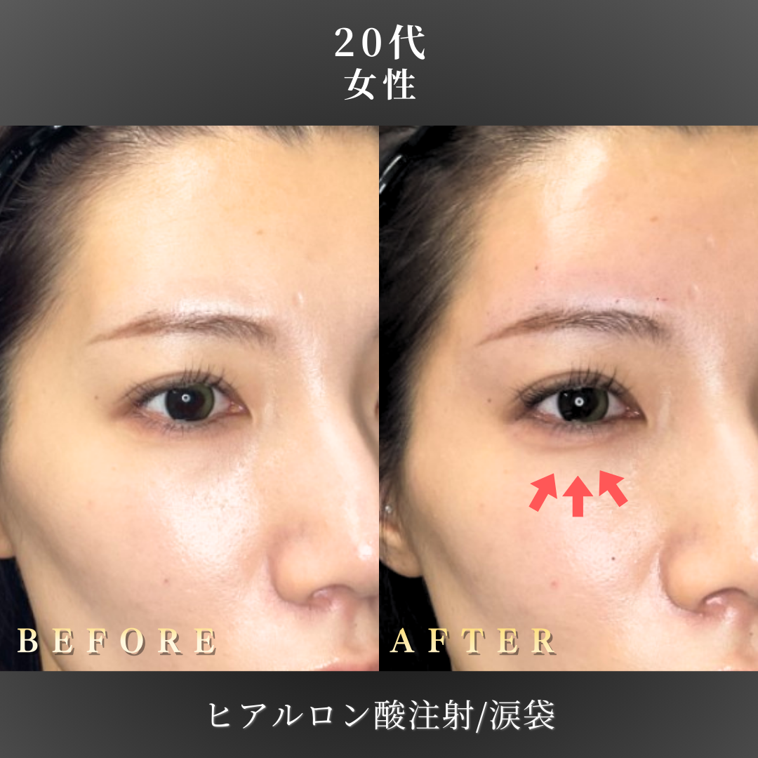 20代 ヒアルロン酸 症例写真〔右斜めB/A〕｜大阪 心斎橋BiBiクリニック