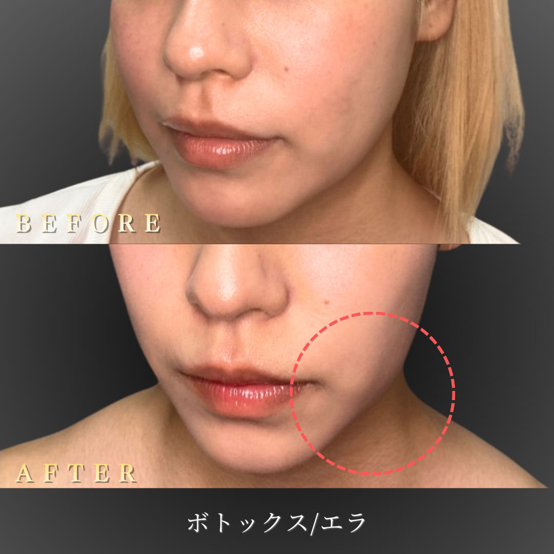 【サブ】20代 エラボトックス 症例写真〔左45度Before/After〕｜大阪 心斎橋BiBiクリニック