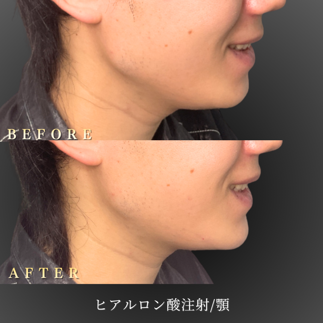 20代男性 顎ヒアルロン酸 症例写真〔右横Before/After〕｜大阪 心斎橋BiBiクリニック