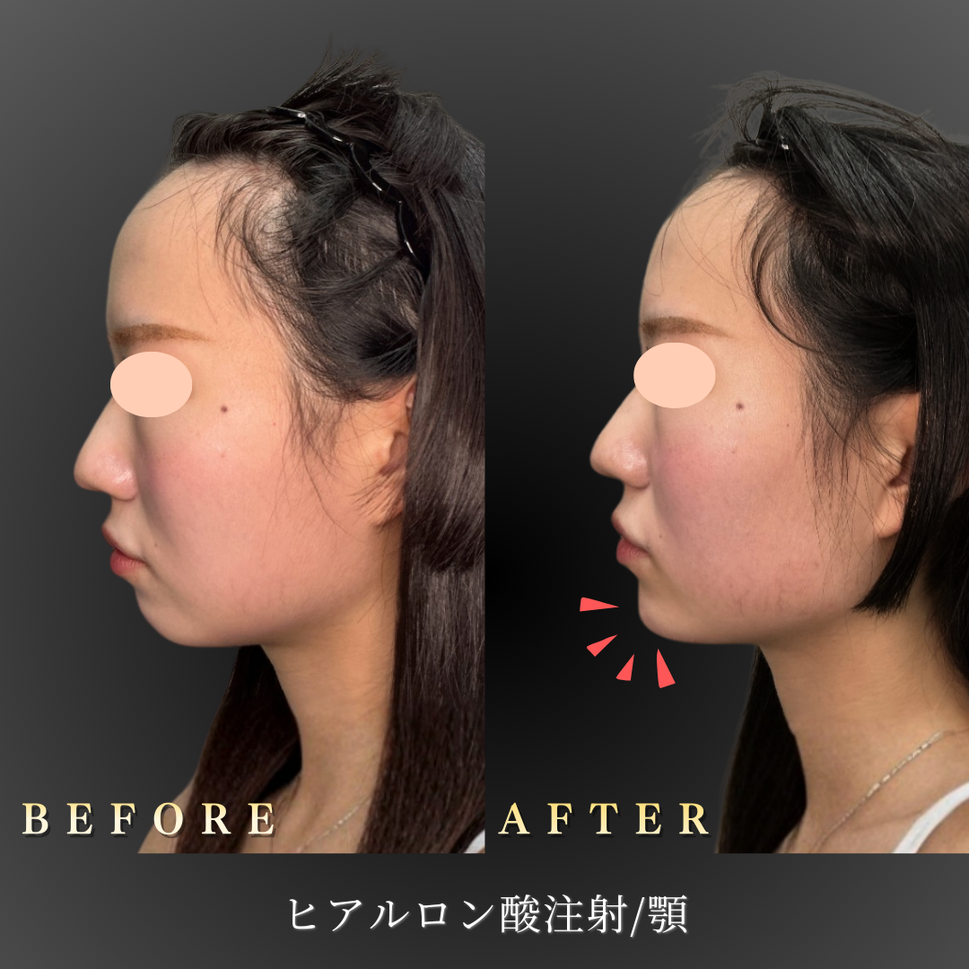 20代女性 顎ヒアルロン酸 症例写真〔左横Before/After〕｜大阪 心斎橋BiBiクリニック