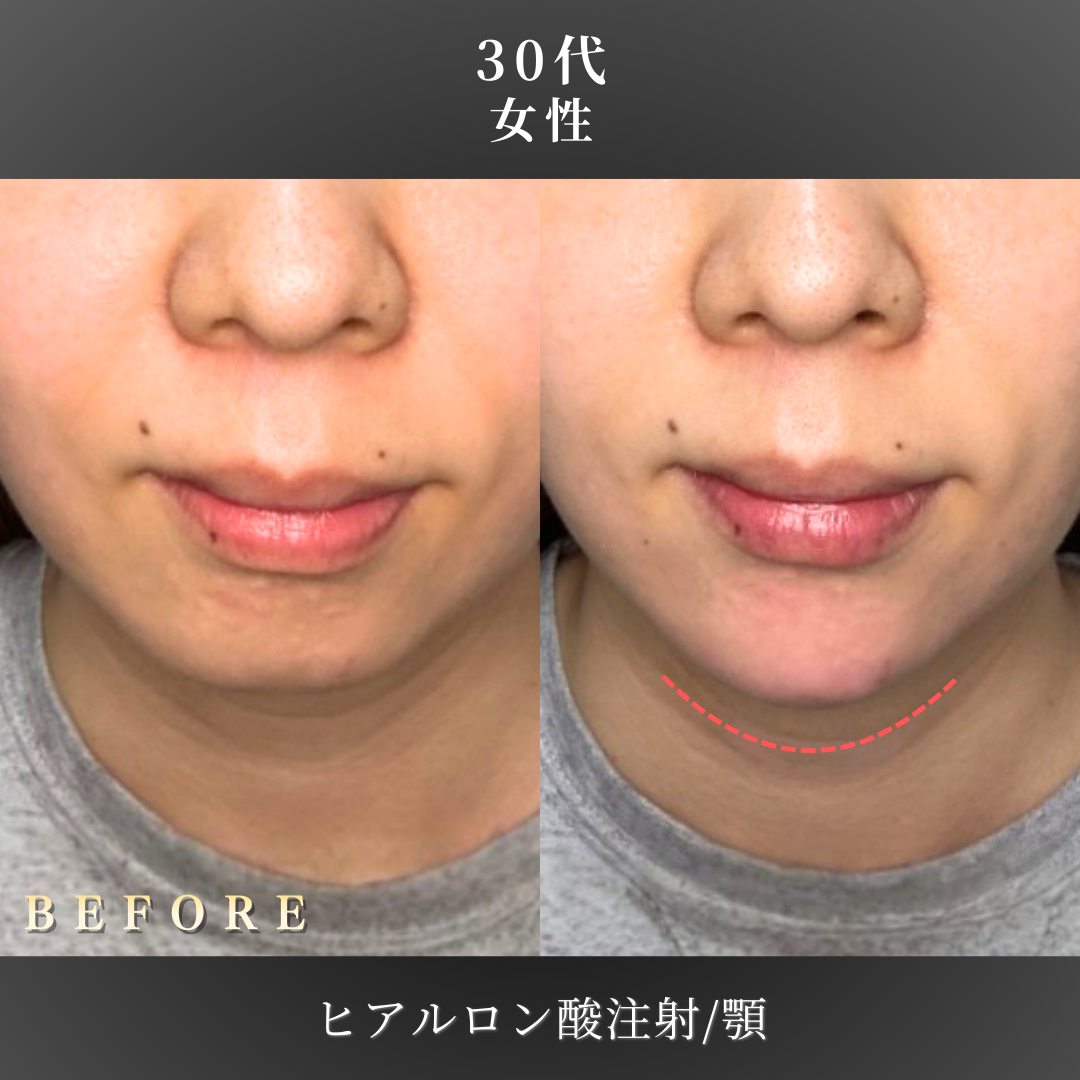 30代 顎ヒアルロン酸 症例写真〔正面B/A〕｜大阪 心斎橋BiBiクリニック