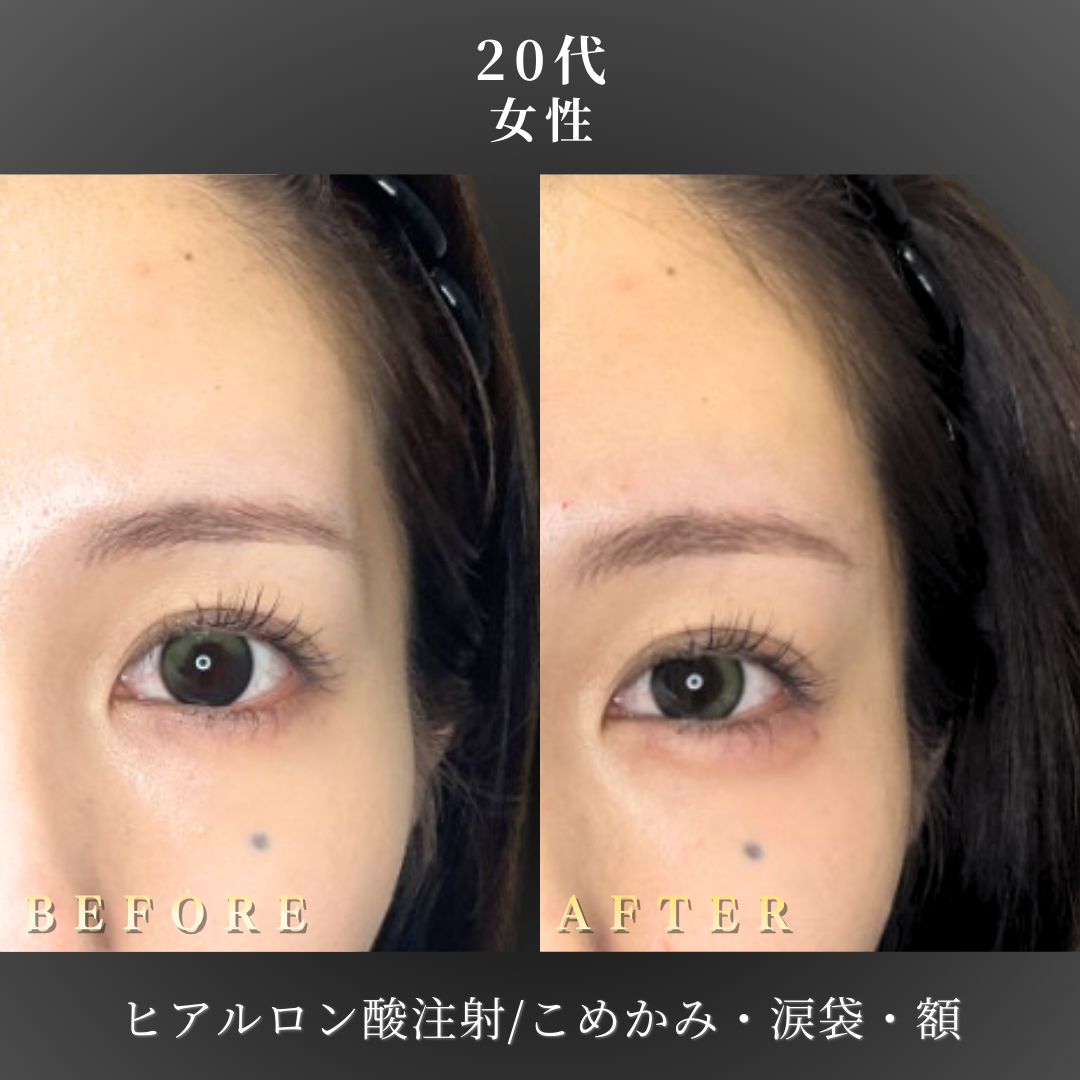 20代女性の涙袋ヒアルロン酸(ボルベラ0.2本)｜大阪心斎橋BiBiクリニック症例の症例写真