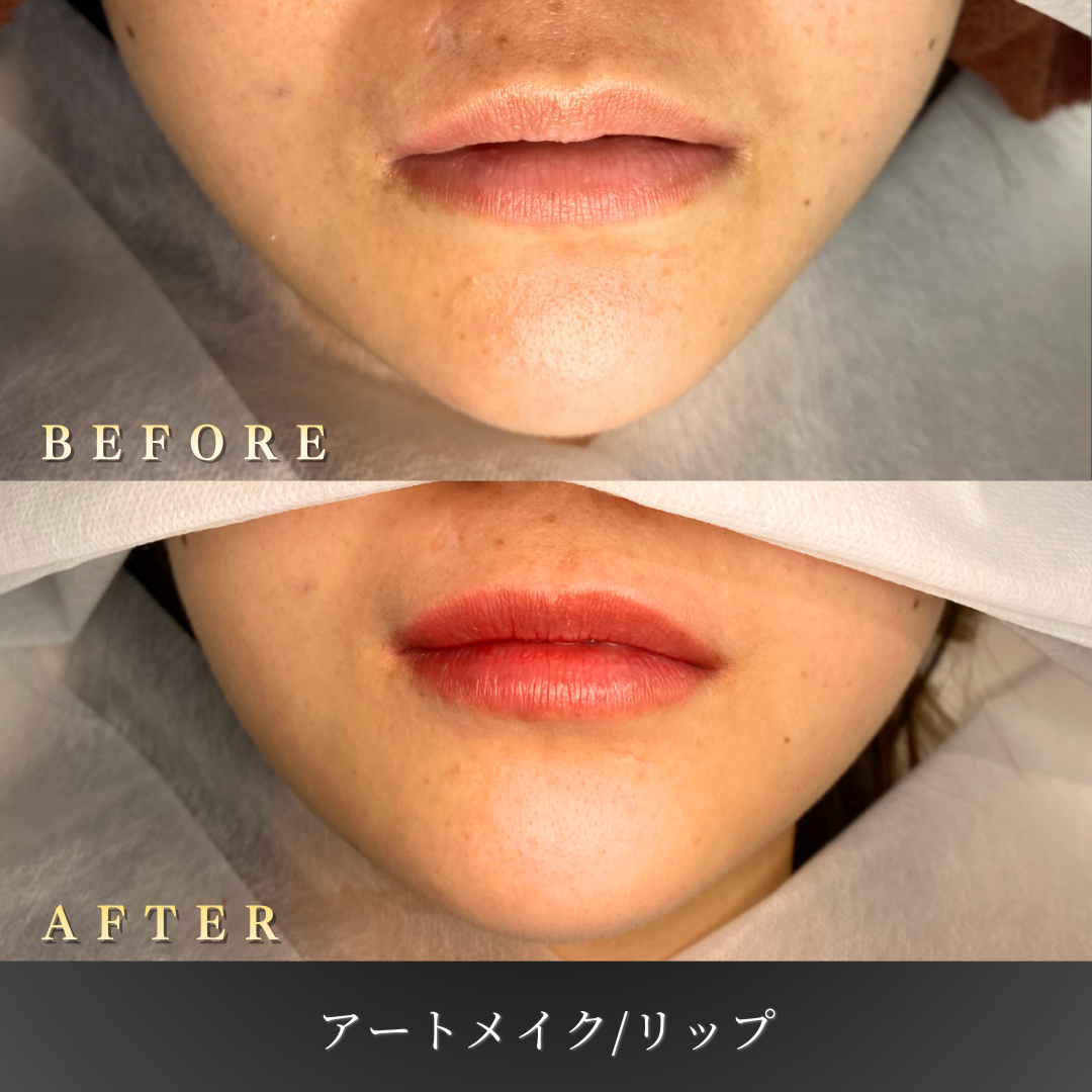 20代 リップアートメイク 症例写真〔正面Before/After〕｜大阪 心斎橋BiBiクリニック