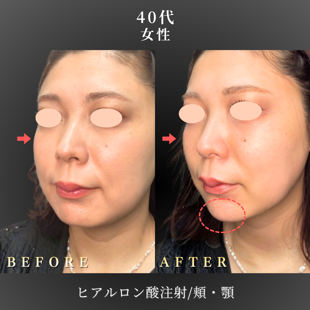 40代 顎ヒアルロン酸 症例写真〔左斜めB/A〕｜大阪 心斎橋BiBiクリニック