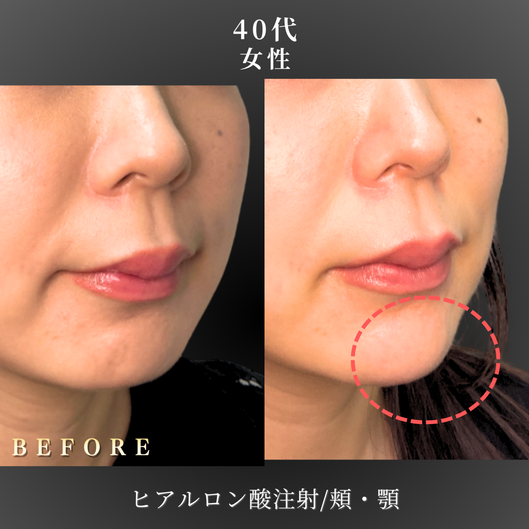 40代 顎ヒアルロン酸 症例写真〔右斜めB/A〕｜大阪 心斎橋BiBiクリニック