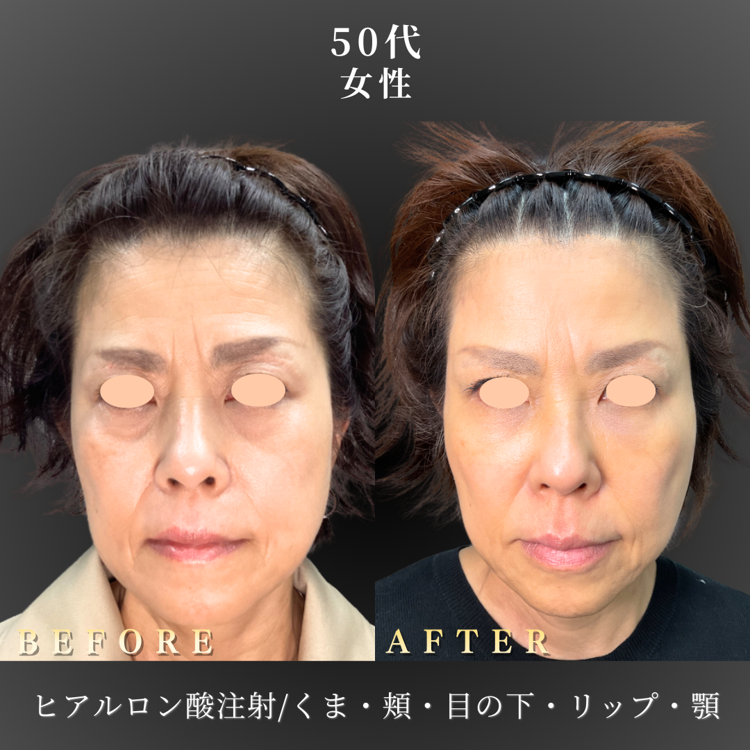 50代 ヒアルロン酸 症例写真〔正面B/A〕｜大阪 心斎橋BiBiクリニック