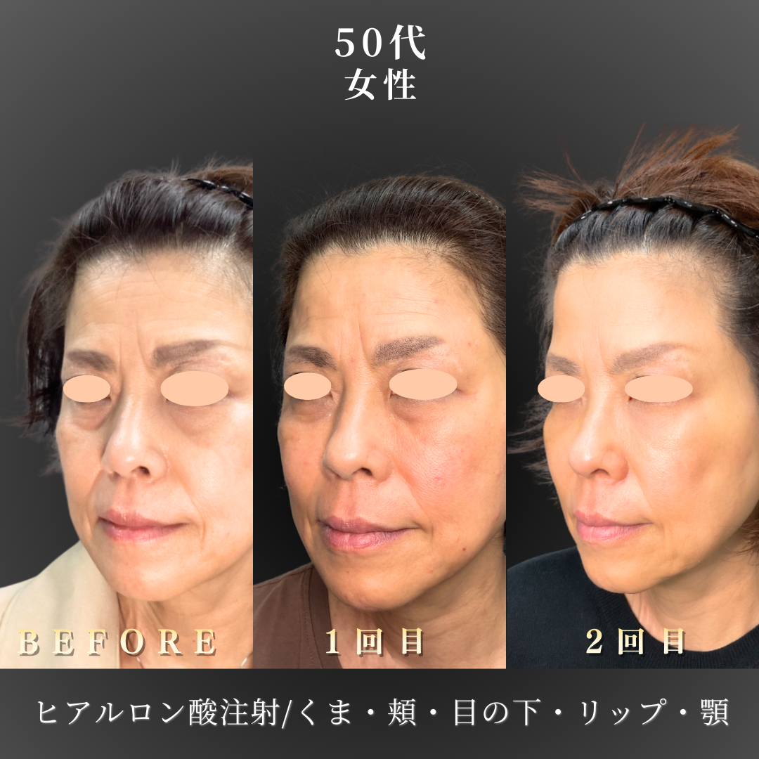 50代 ヒアルロン酸 症例写真〔左斜めB/A〕｜大阪 心斎橋BiBiクリニック