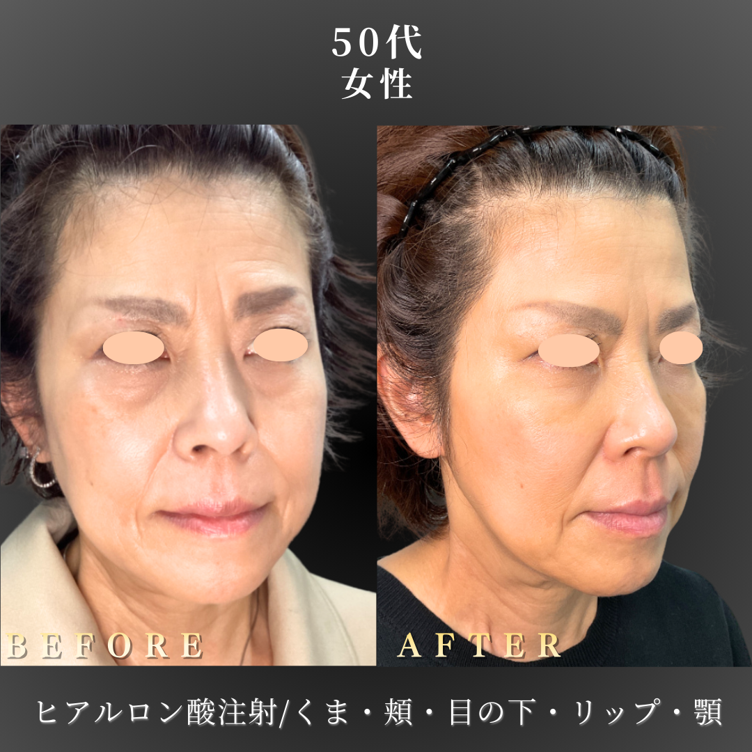 50代 ヒアルロン酸 症例写真〔右斜めB/A〕｜大阪 心斎橋BiBiクリニック