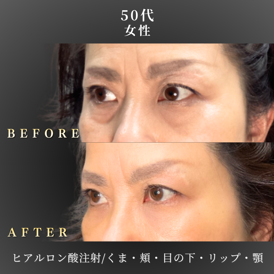50代 ヒアルロン酸 症例写真〔左斜めB/A〕｜大阪 心斎橋BiBiクリニック