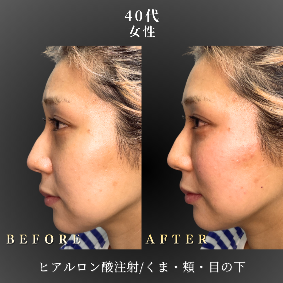 40代 ヒアルロン酸 症例写真〔左横B/A〕｜大阪 心斎橋BiBiクリニック