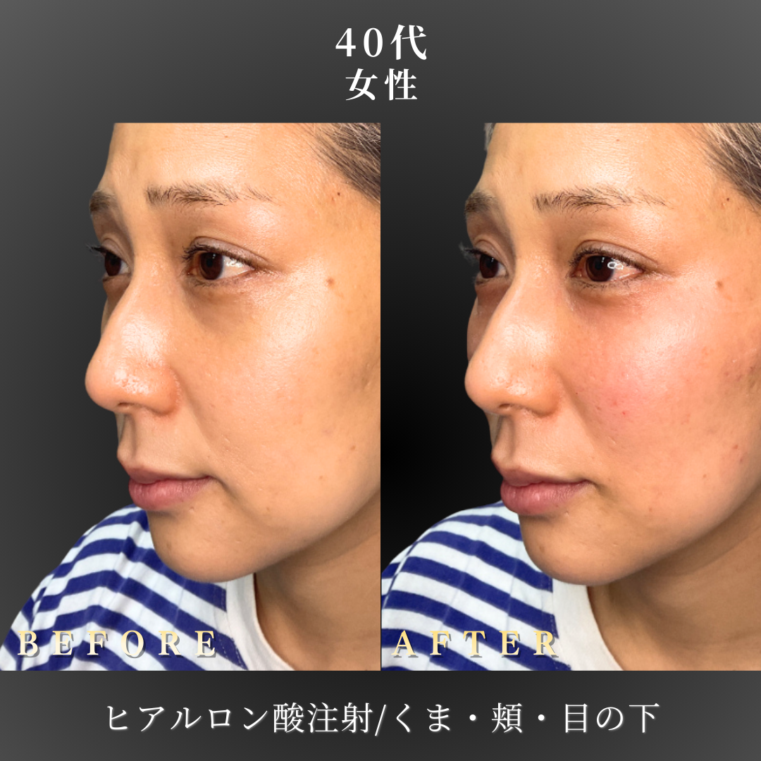 40代 ヒアルロン酸 症例写真〔左斜めB/A〕｜大阪 心斎橋BiBiクリニック