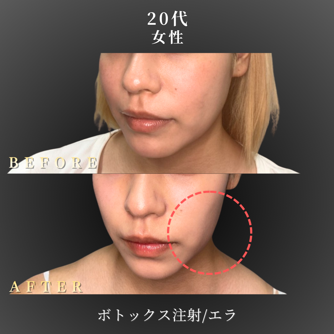 20代 エラボトックス 症例写真〔左斜めB/A〕｜大阪 心斎橋BiBiクリニック