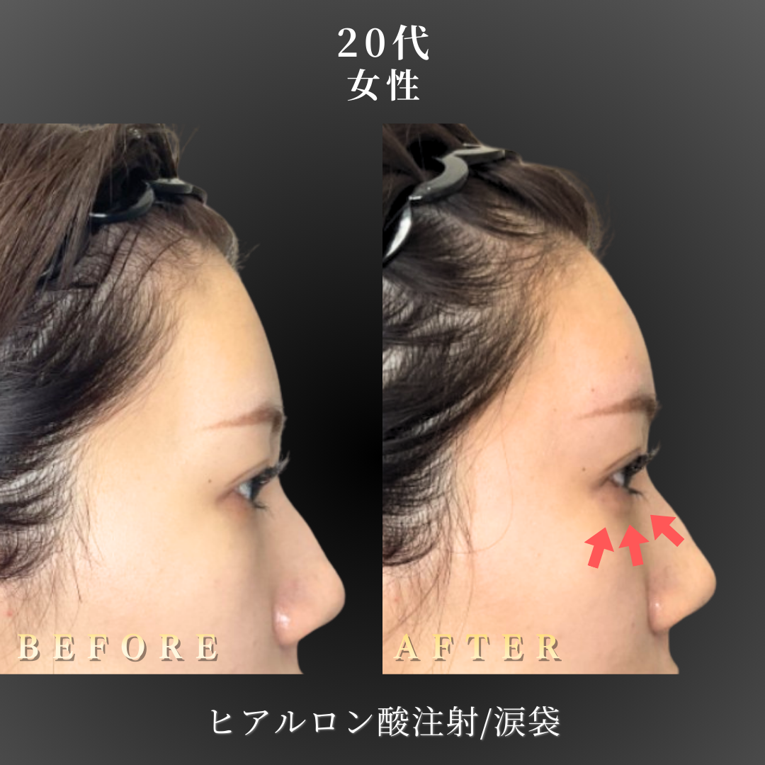 20代 ヒアルロン酸 症例写真〔右横B/A〕｜大阪 心斎橋BiBiクリニック