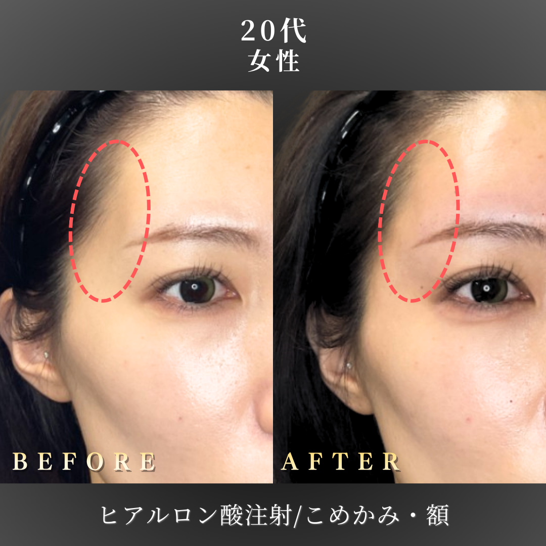 20代 ヒアルロン酸 症例写真〔右斜めB/A〕｜大阪 心斎橋BiBiクリニック