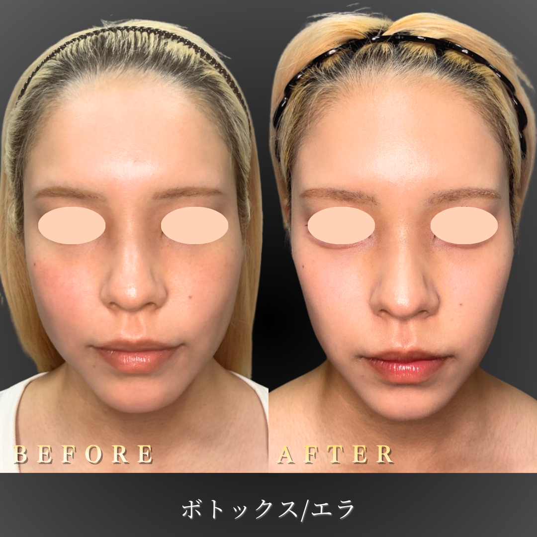 【サブ】20代 エラボトックス 症例写真〔正面Before/After〕｜大阪 心斎橋BiBiクリニック