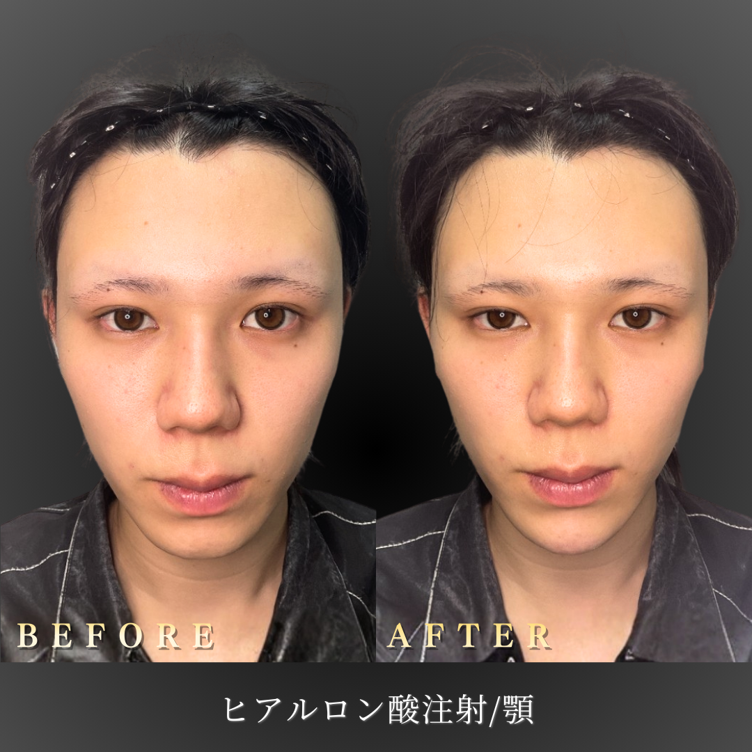 20代男性 顎ヒアルロン酸 症例写真〔正面Before/After〕｜大阪 心斎橋BiBiクリニック
