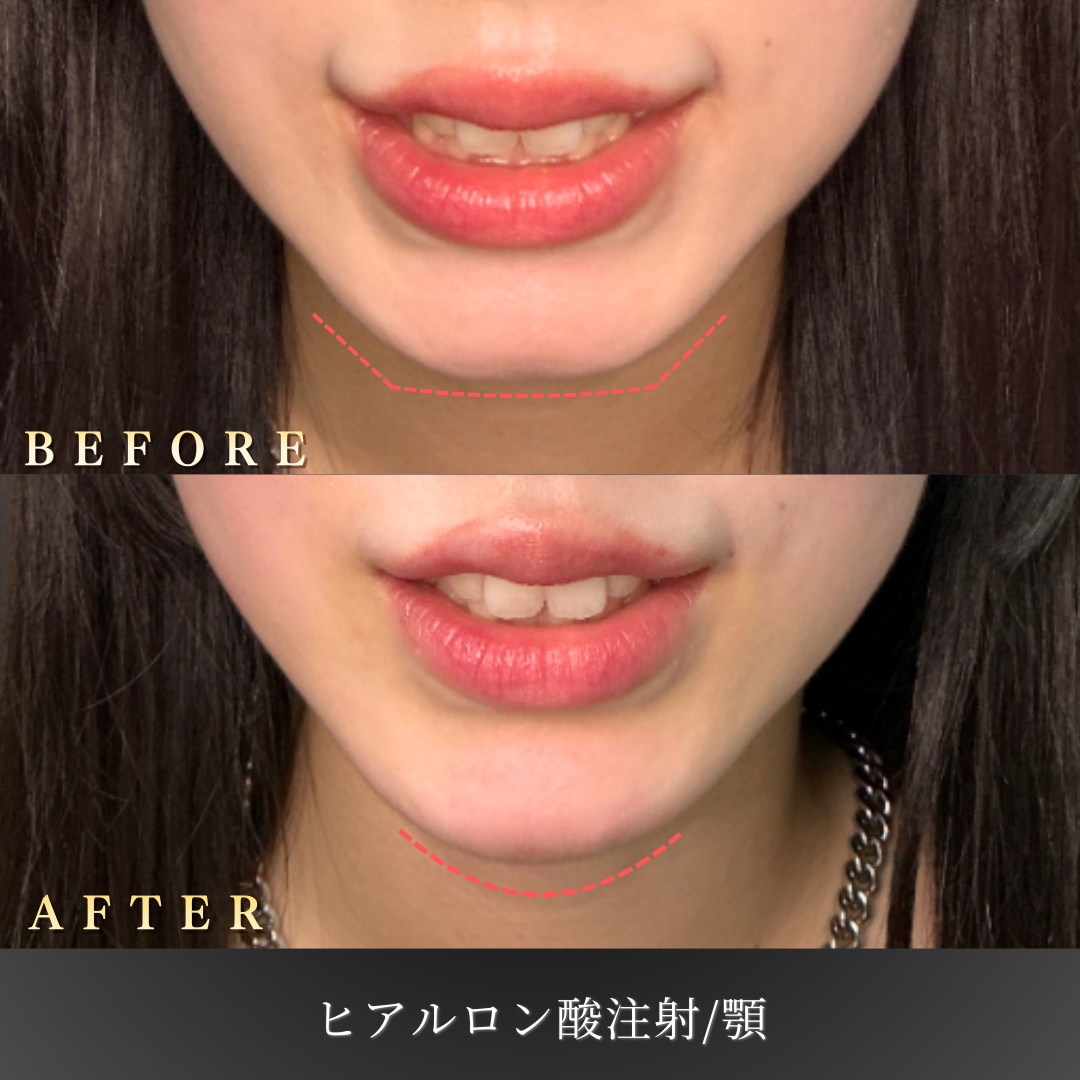 20代女性 顎ヒアルロン酸 症例写真〔正面Before/After〕｜大阪 心斎橋BiBiクリニック