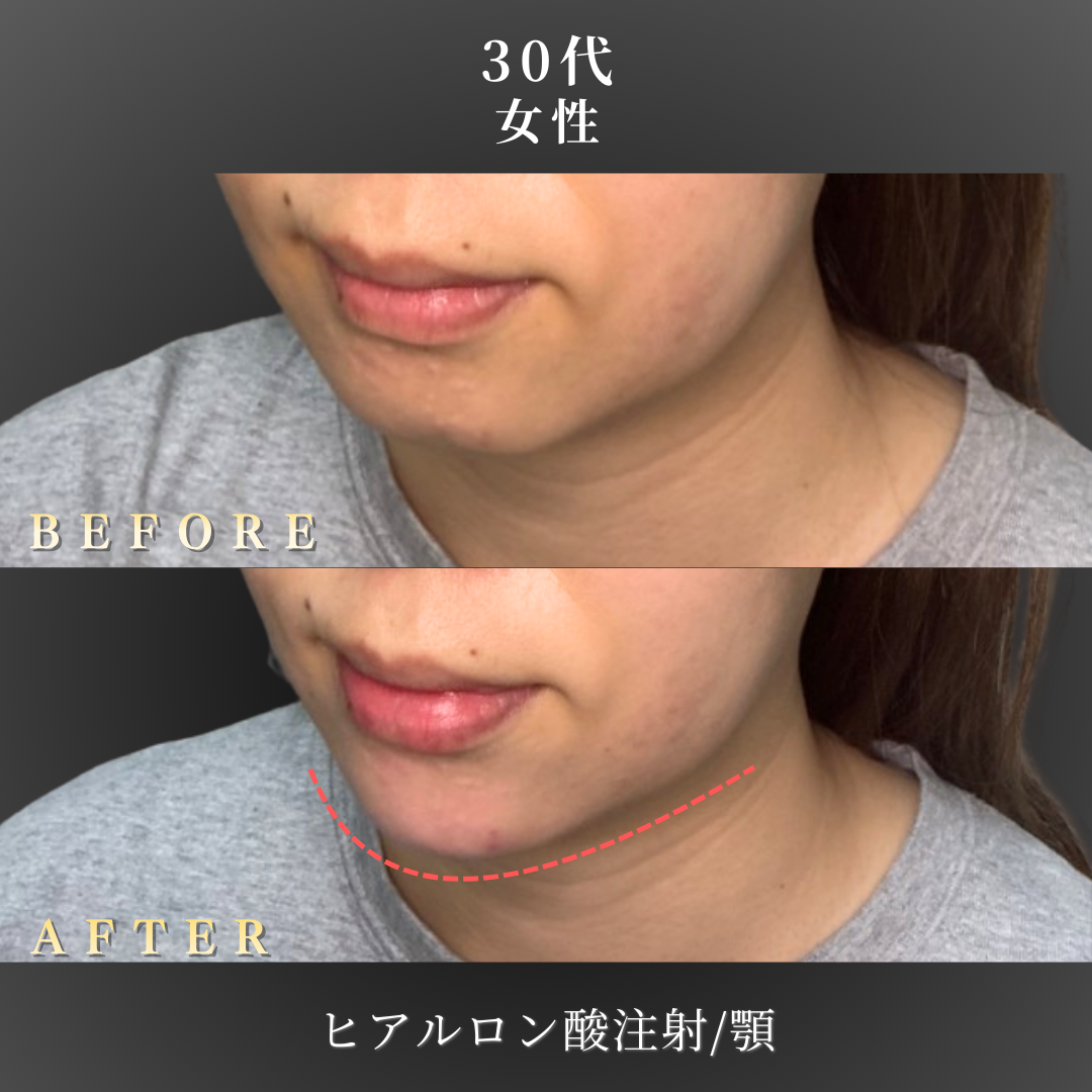30代 顎ヒアルロン酸 症例写真〔左斜めB/A〕｜大阪 心斎橋BiBiクリニック