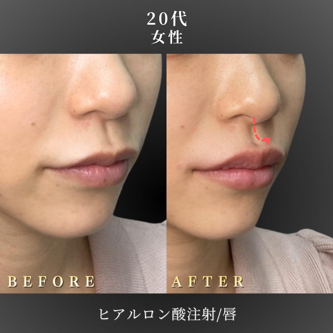 20代 ヒアルロン酸 症例写真〔右斜めB/A〕｜大阪 心斎橋BiBiクリニック