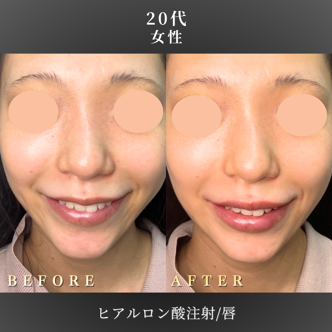 20代 ヒアルロン酸 症例写真〔正面笑顔B/A〕｜大阪 心斎橋BiBiクリニック