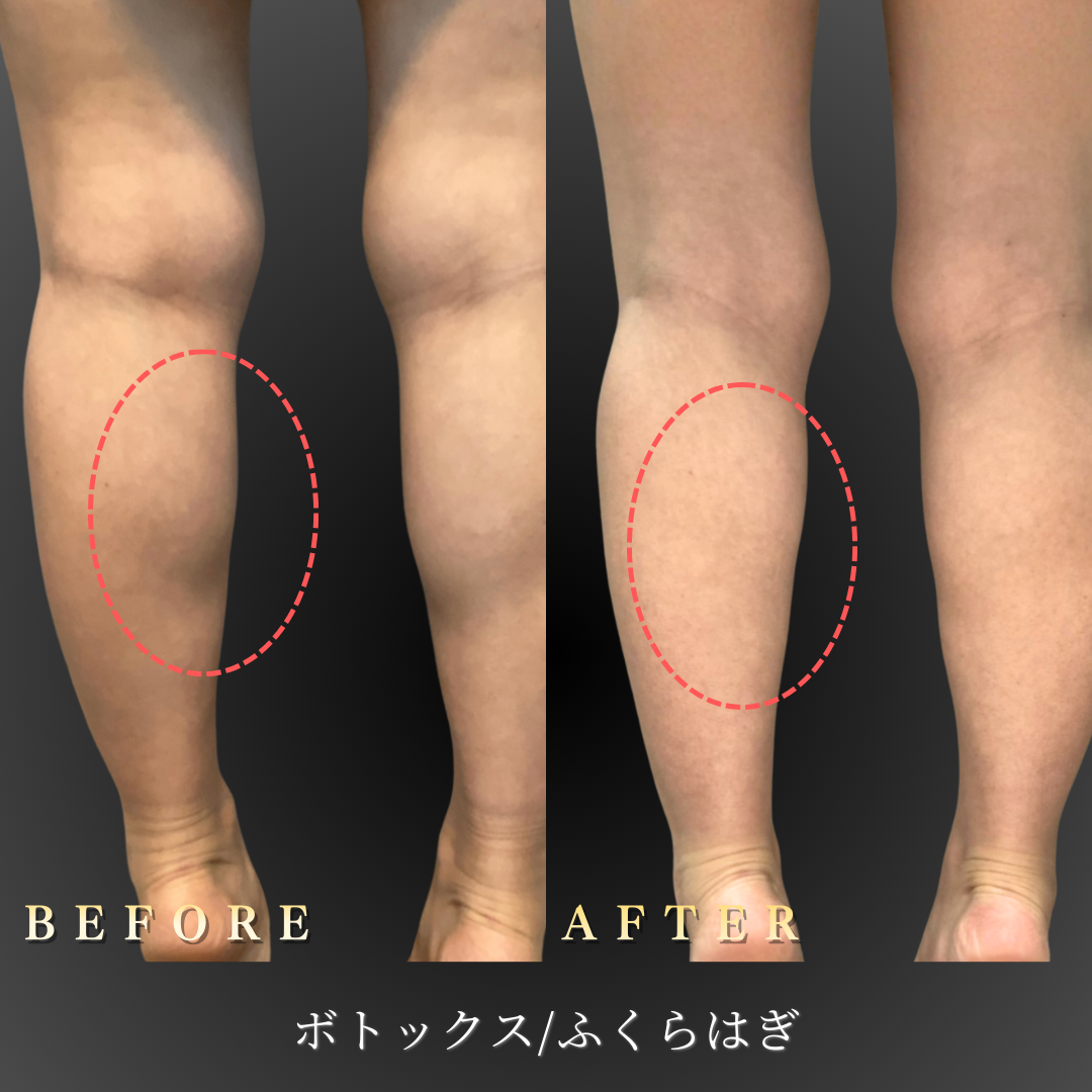 20代 ふくらはぎボトックス 症例写真〔背面Before/After〕｜大阪 心斎橋BiBiクリニック