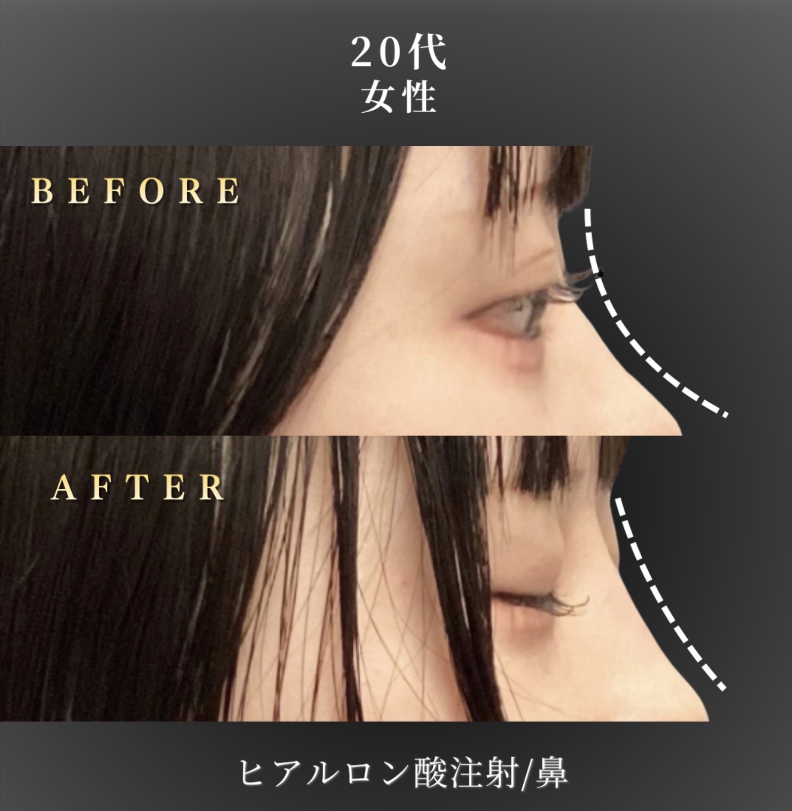 20代 鼻ヒアルロン酸 症例写真〔右90度Before/After〕｜大阪 心斎橋BiBiクリニック