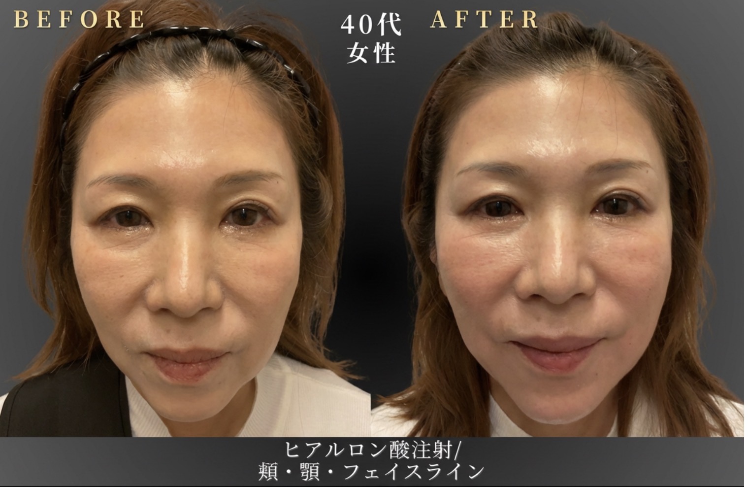 40代 目の下、顎ヒアルロン酸 症例写真〔正面B/A〕｜大阪 心斎橋BiBiクリニック