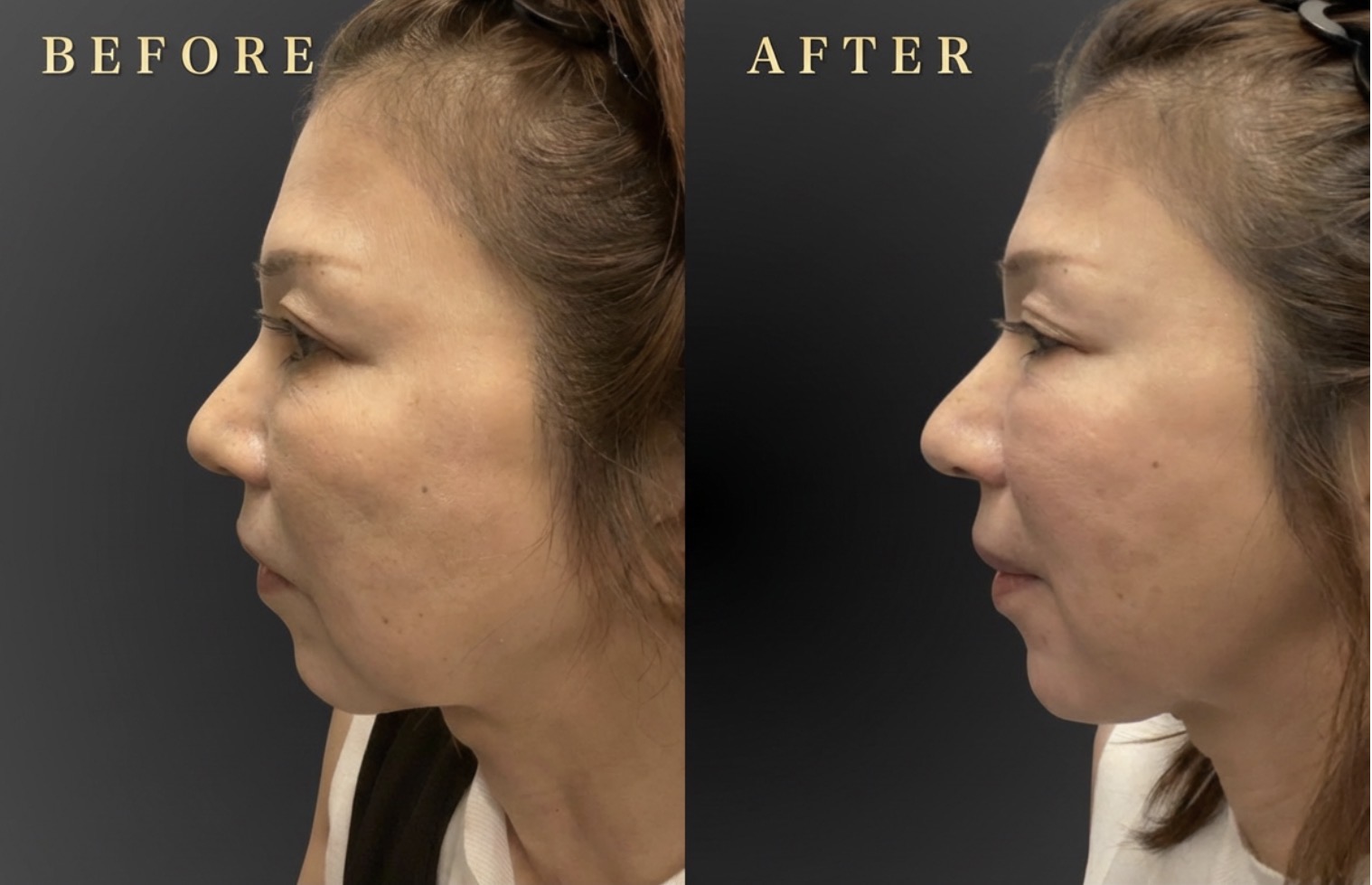 40代 目の下、顎ヒアルロン酸 症例写真〔左B/A〕｜大阪 心斎橋BiBiクリニック