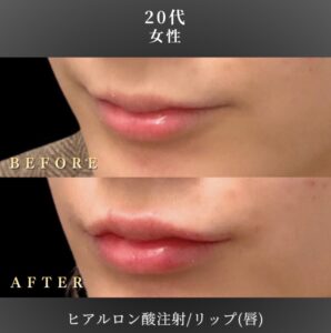 Alt: 20代 唇ヒアルロン酸 症例写真〔左斜めB/A〕｜大阪 心斎橋BiBiクリニック