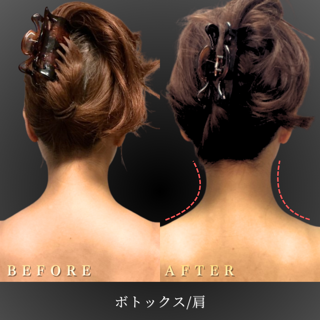 30代 肩ボトックス 症例写真〔背面Before/After〕｜大阪 心斎橋BiBiクリニック