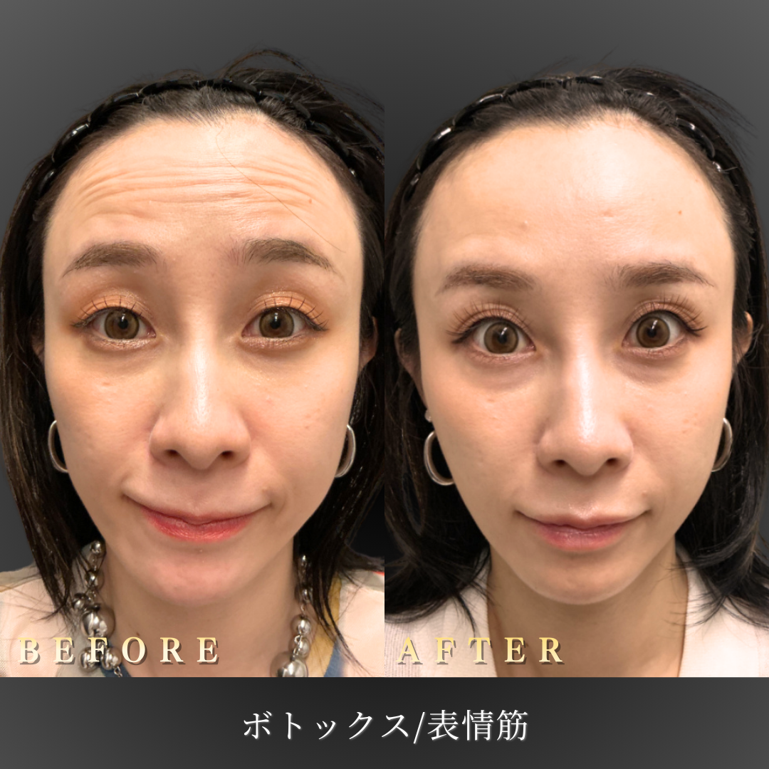 30代 表情筋ボトックス 症例写真〔正面Before/After〕｜大阪 心斎橋BiBiクリニック