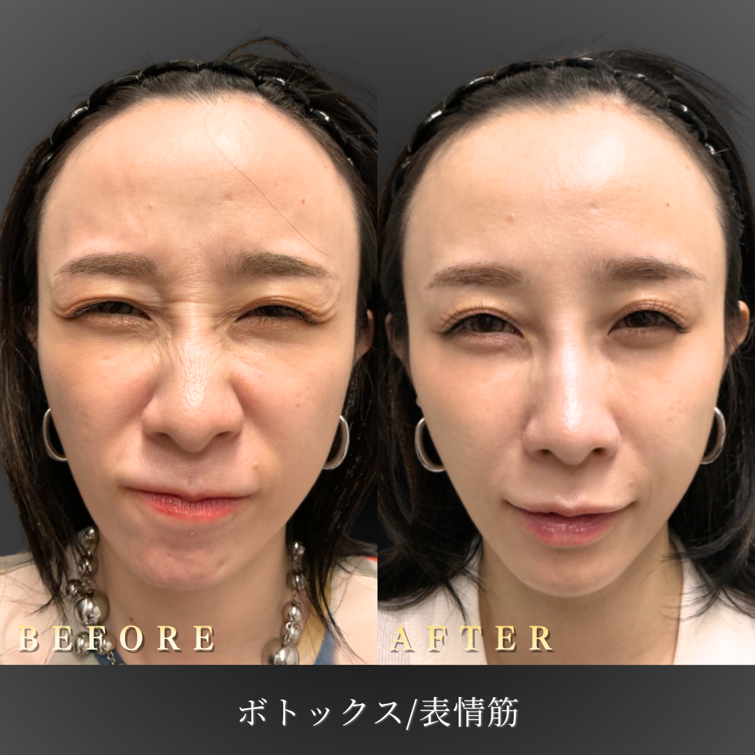 30代 表情筋ボトックス 症例写真〔正面Before/After〕｜大阪 心斎橋BiBiクリニック