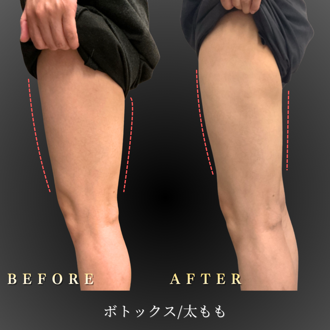 30代 太ももボトックス 症例写真〔左横Before/After〕｜大阪 心斎橋BiBiクリニック