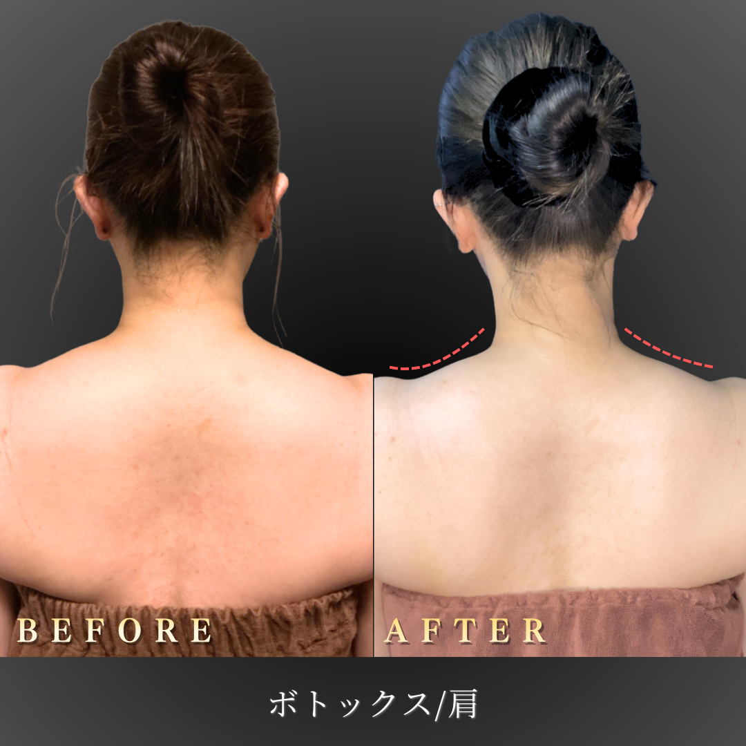 40代 肩ボトックス 症例写真〔背面Before/After〕｜大阪 心斎橋BiBiクリニック