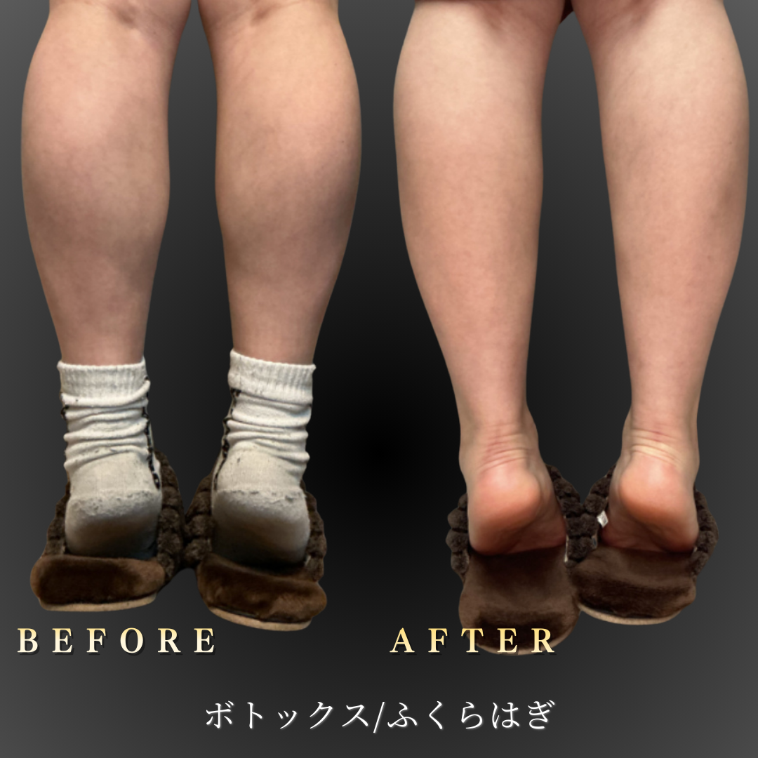 30代 ふくらはぎボトックス 症例写真〔背面Before/After〕｜大阪 心斎橋BiBiクリニック