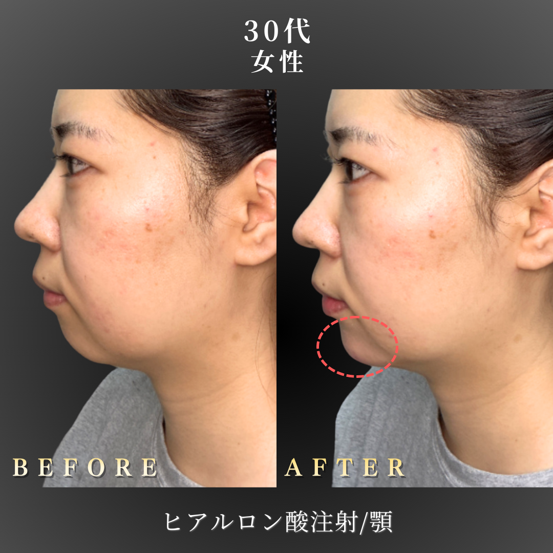30代 顎ヒアルロン酸 症例写真〔横B/A〕｜大阪 心斎橋BiBiクリニック