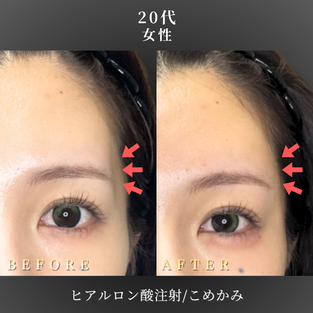 【20代女性】女性らしい丸みを作るこめかみヒアルロン酸症例｜大阪 心斎橋BiBiクリニックの症例写真
