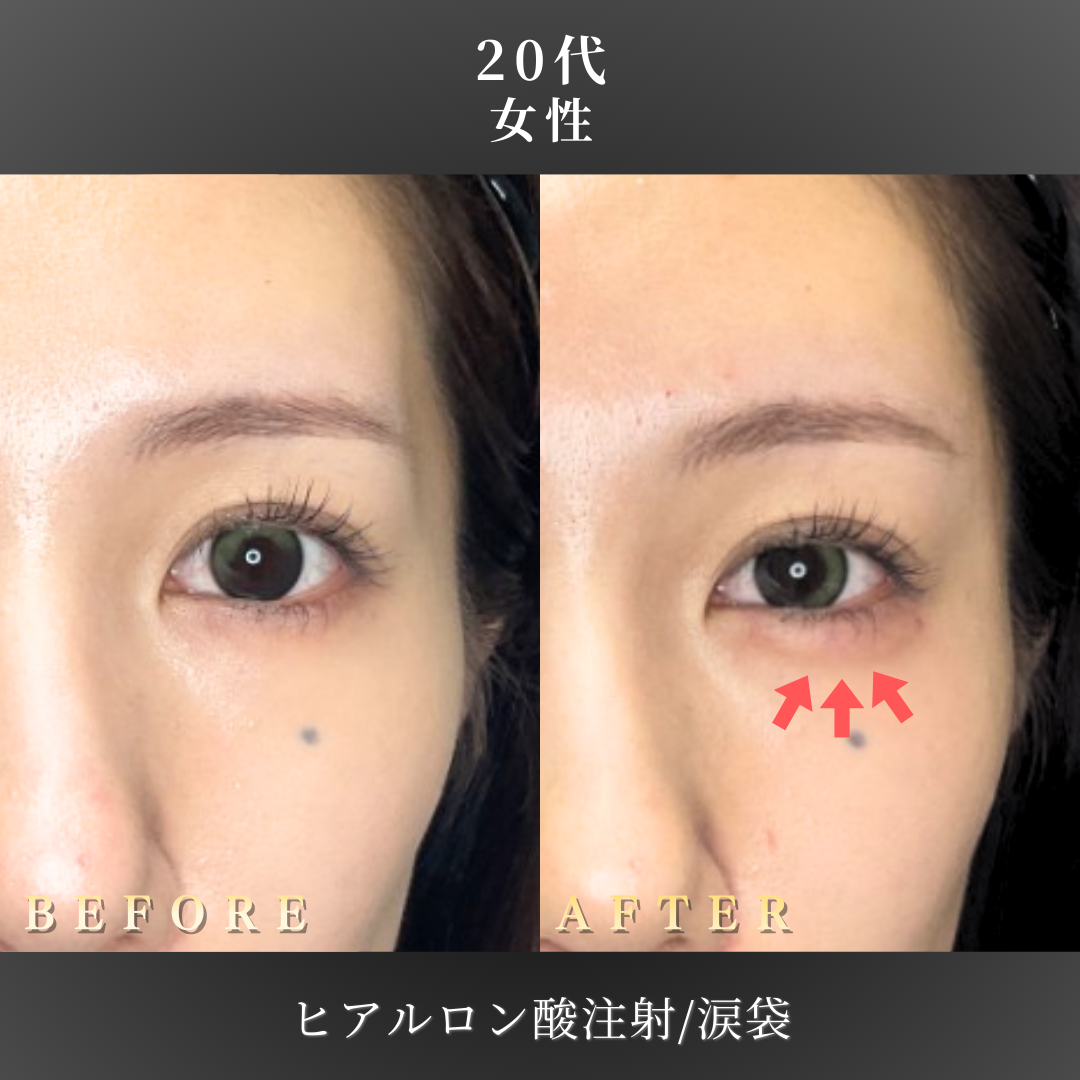20代 ヒアルロン酸 症例写真〔正面B/A〕｜大阪 心斎橋BiBiクリニック