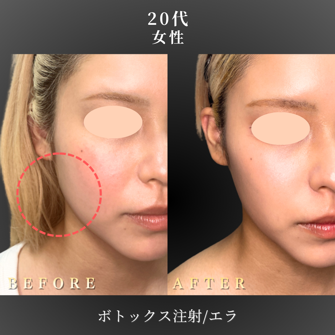 20代 エラボトックス 症例写真〔右斜めB/A〕｜大阪 心斎橋BiBiクリニック