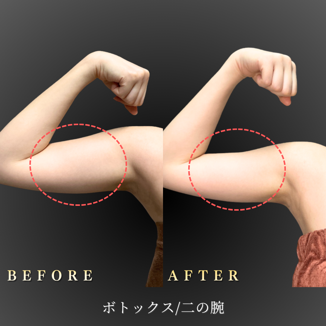 20代 二の腕ボトックス 症例写真〔正面Before/After〕｜大阪 心斎橋BiBiクリニック