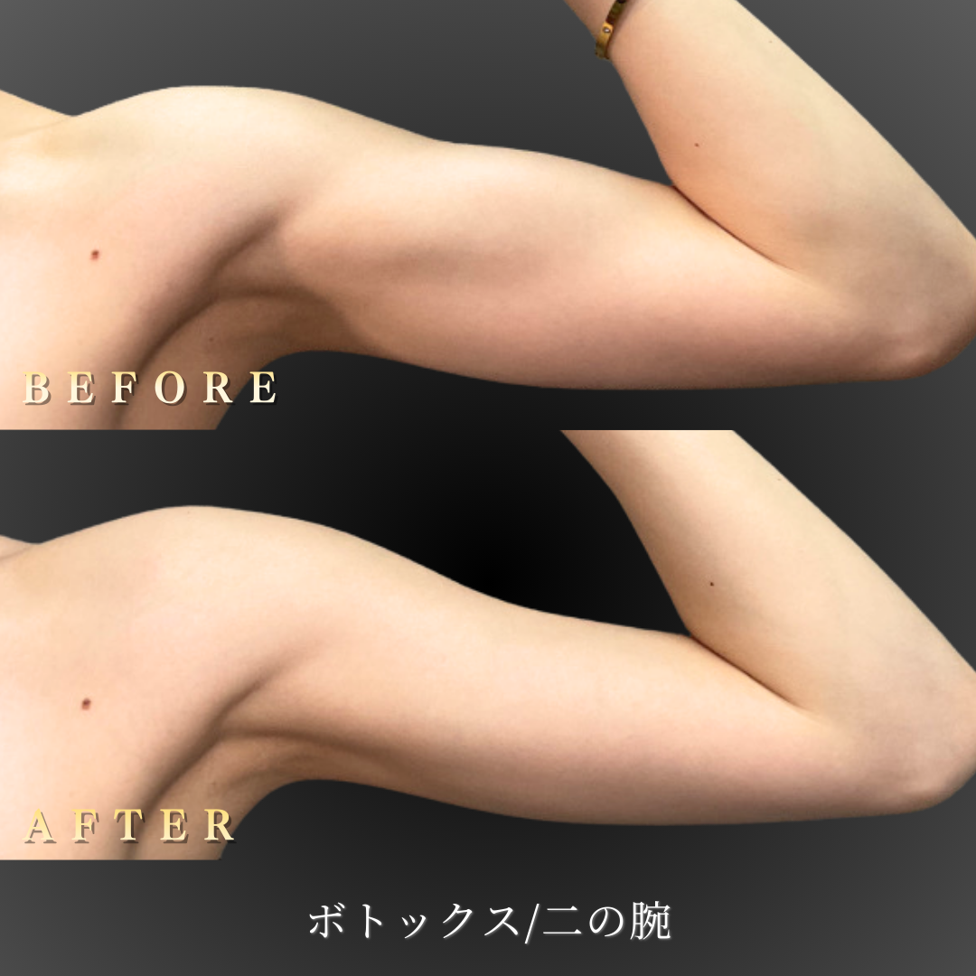 20代 二の腕ボトックス 症例写真〔正面Before/After〕｜大阪 心斎橋BiBiクリニック