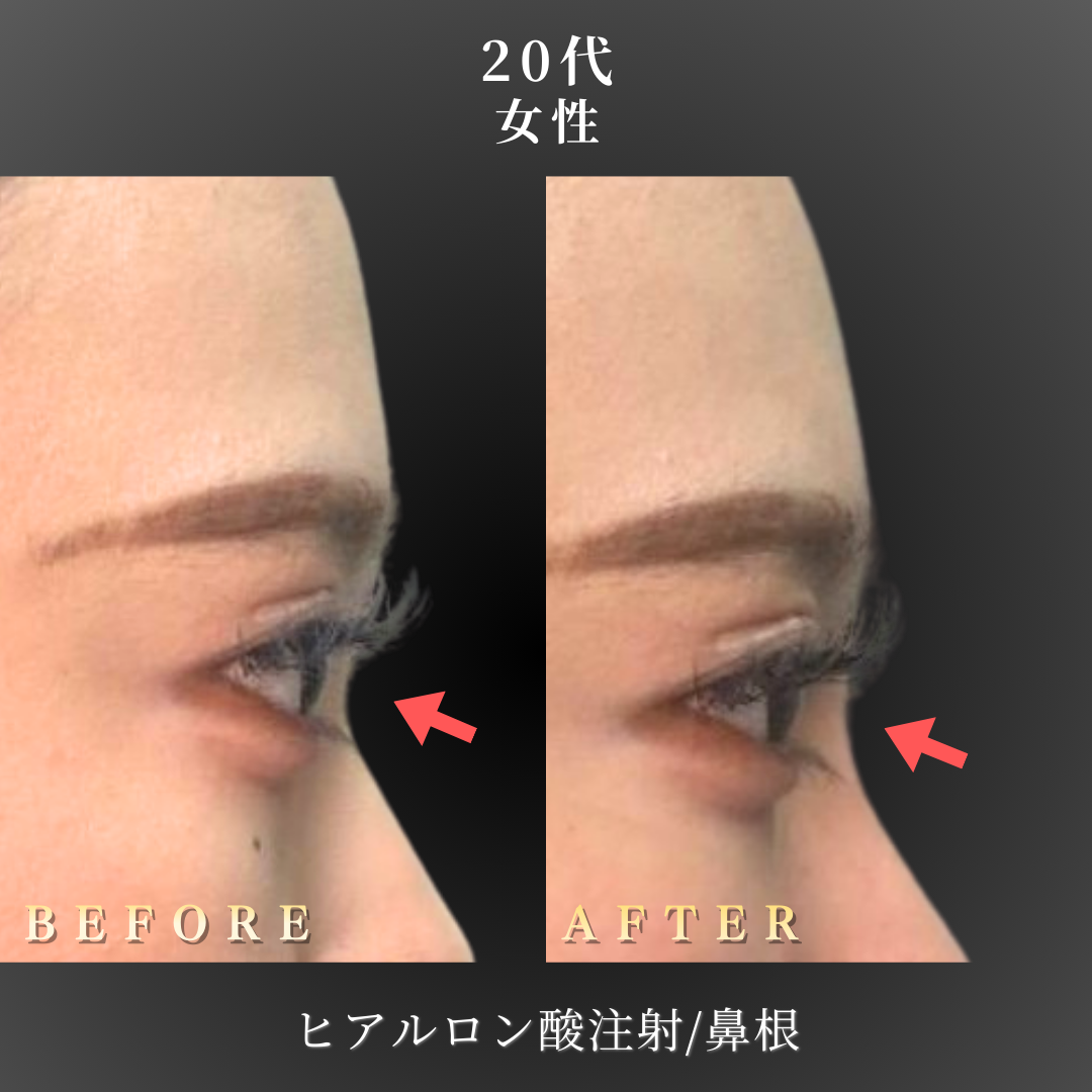 20代 ヒアルロン酸 症例写真〔右横 B/A〕｜大阪 心斎橋BiBiクリニック