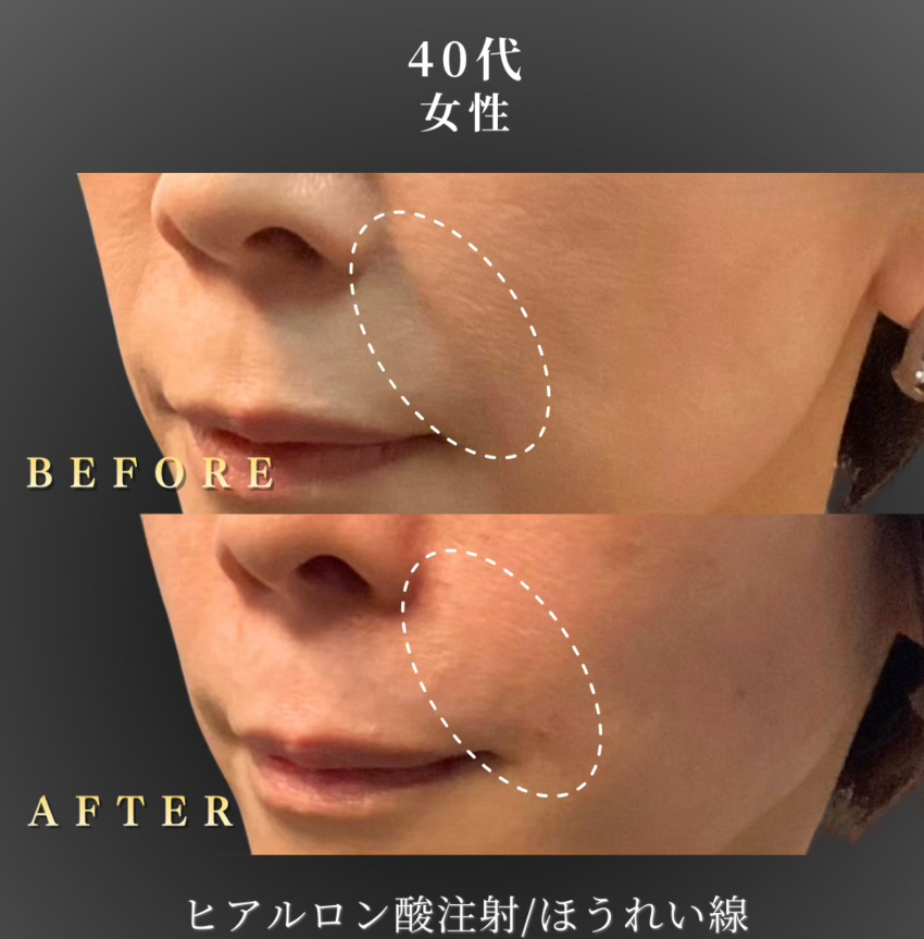 40代 ほうれい線ヒアルロン酸 症例写真〔右45度Before/After〕｜大阪 心斎橋BiBiクリニック