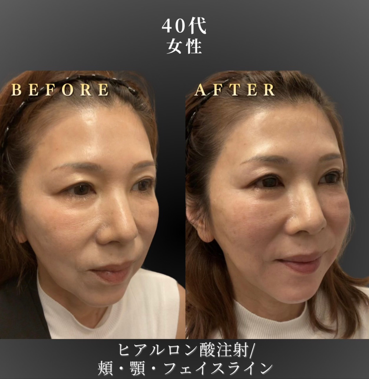 40代 目の下、顎ヒアルロン酸 症例写真〔右B/A〕｜大阪 心斎橋BiBiクリニック