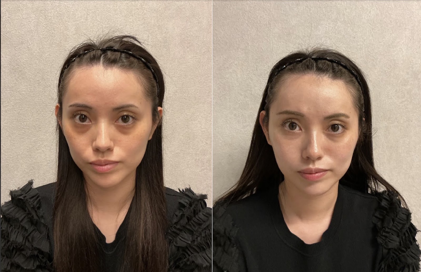 症例写真20代 クマ・頬ヒアルロン酸〔正面Before/After〕