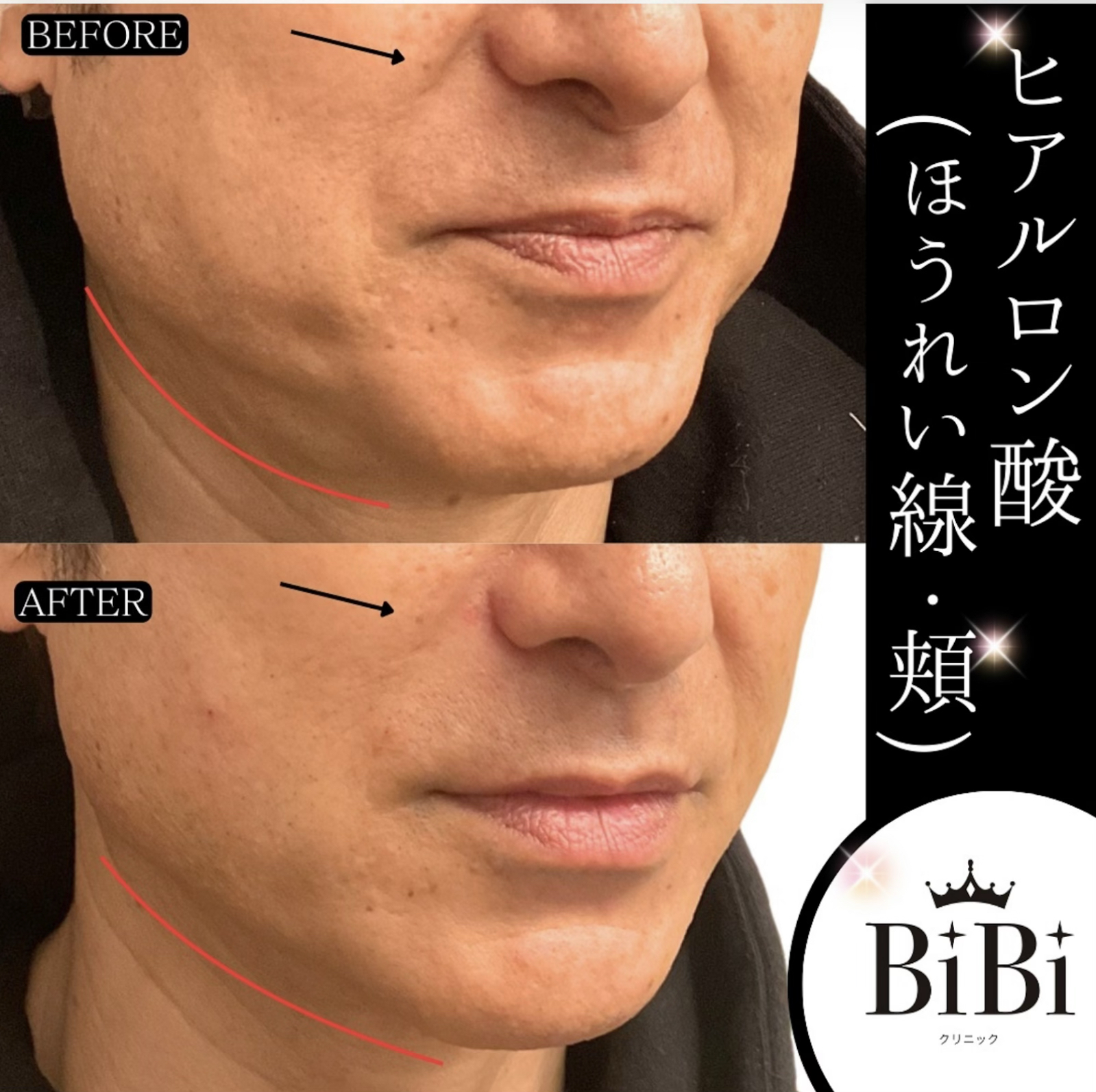 40代 ほうれい線ヒアルロン酸 症例写真〔右45度Before/After〕｜大阪 心斎橋BiBiクリニック