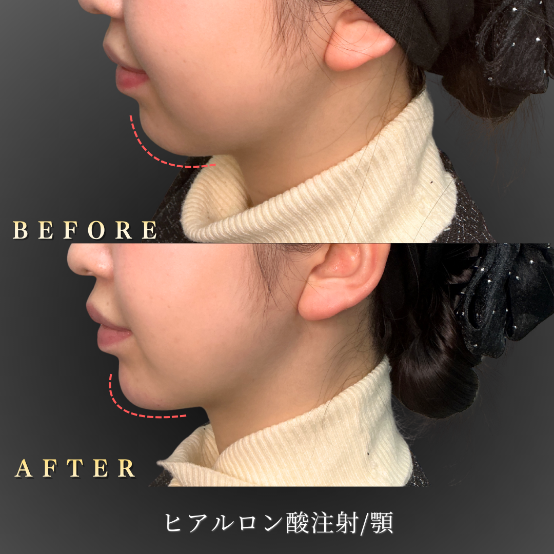 【20代女性】口元の突出感を抑える顎ヒアルロン酸症例｜大阪 心斎橋BiBiクリニックの症例写真