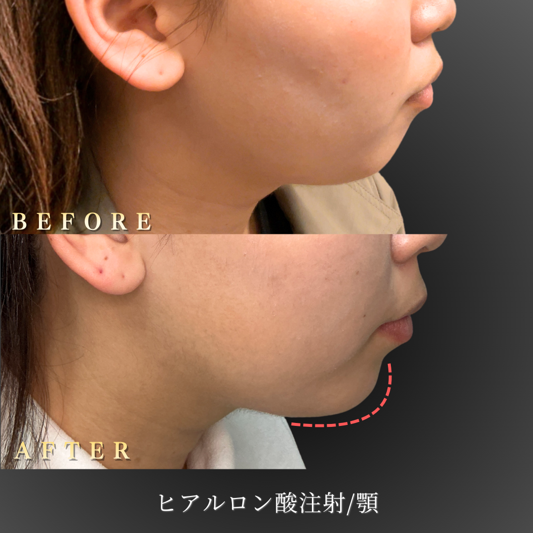 【20代女性】写真映えを意識した顎ヒアルロン酸症例｜大阪 心斎橋BiBiクリニックの症例写真