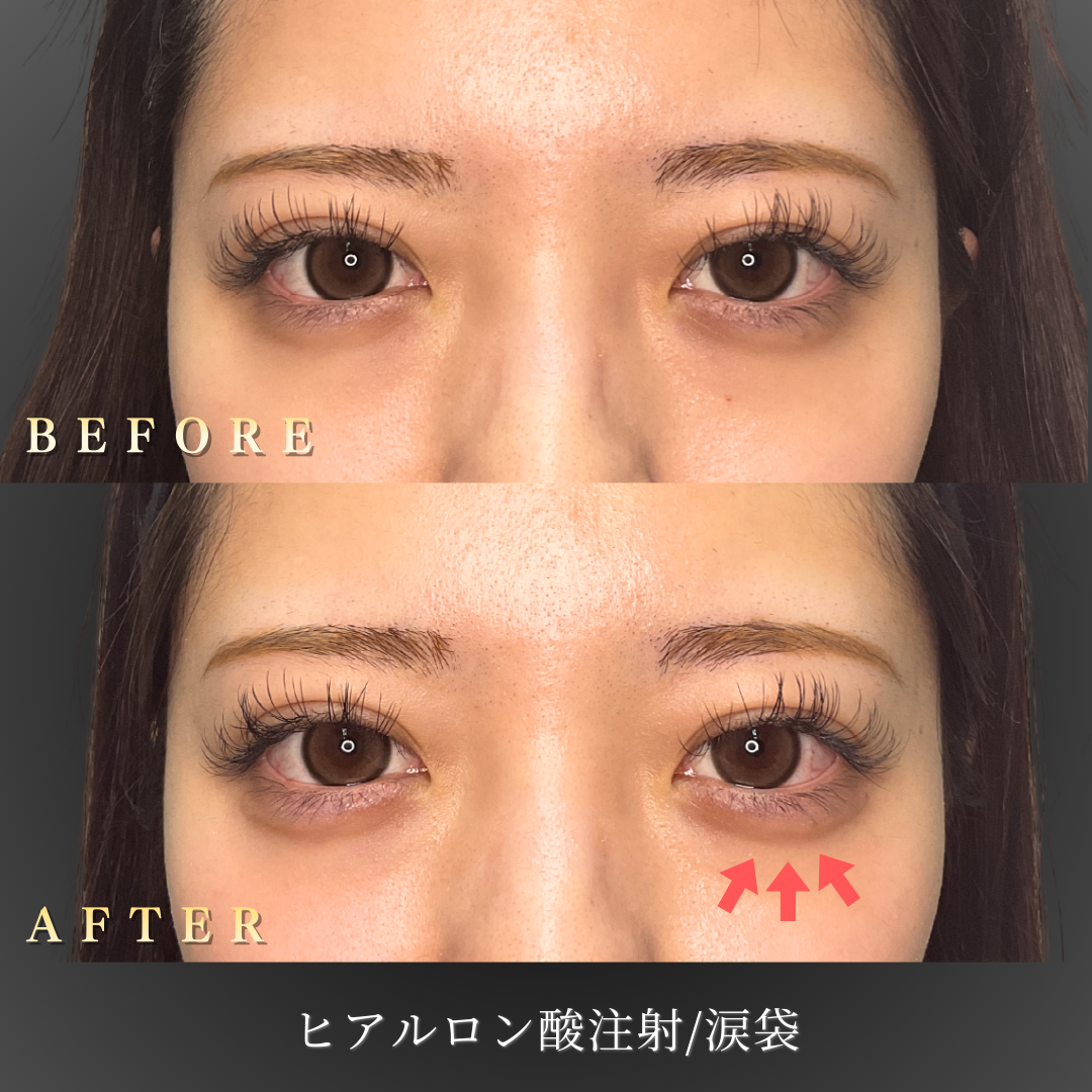 20代 涙袋ヒアルロン酸 症例写真〔正面Before/After〕｜大阪 心斎橋BiBiクリニック