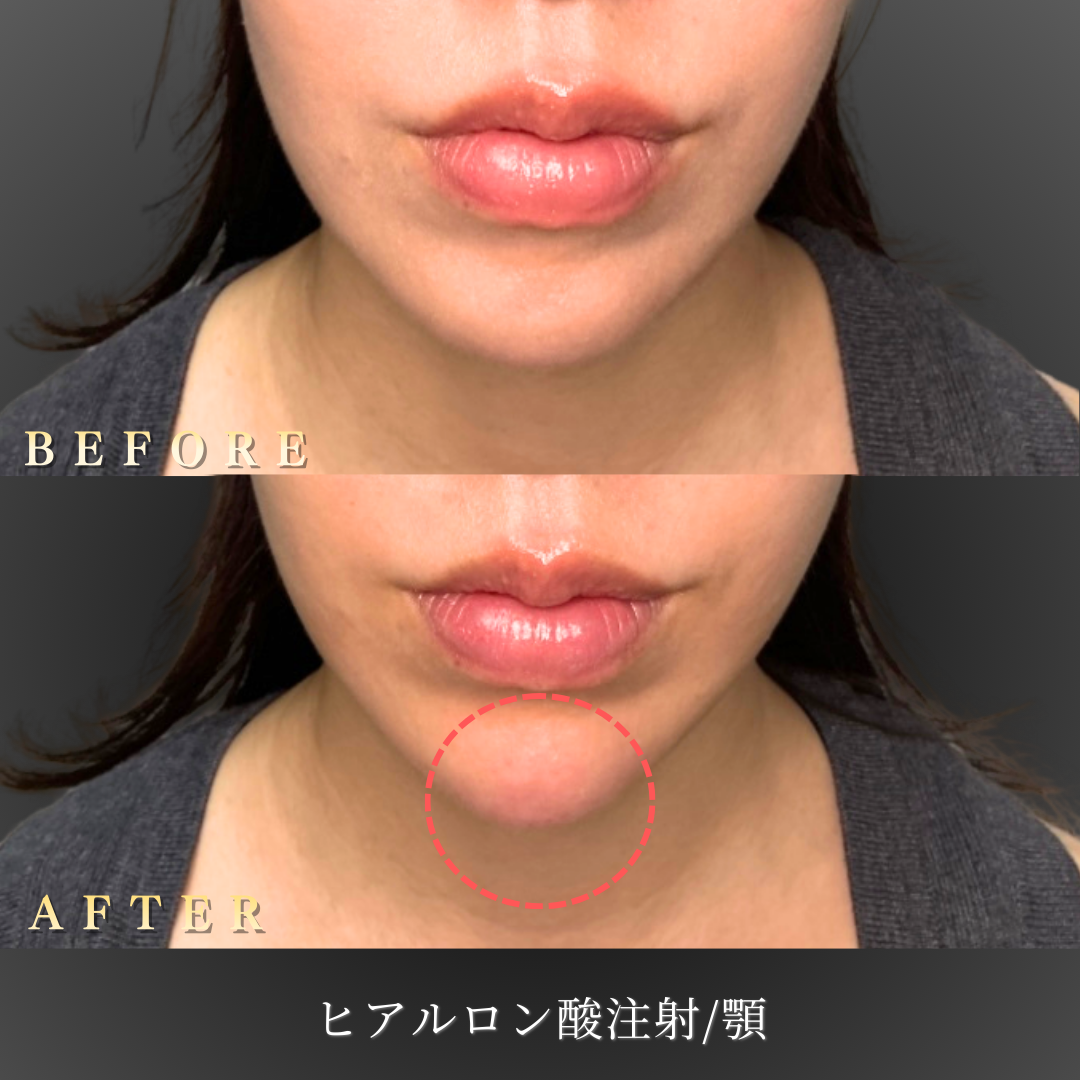 30代 顎ヒアルロン酸 症例写真〔正面Before/After〕｜大阪 心斎橋BiBiクリニック
